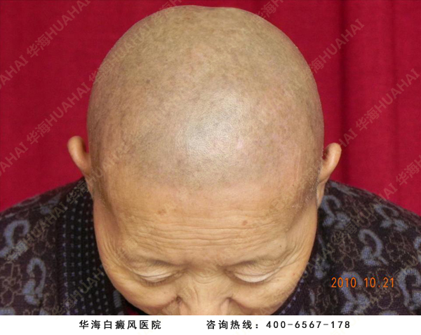 老年女性白癜风治疗