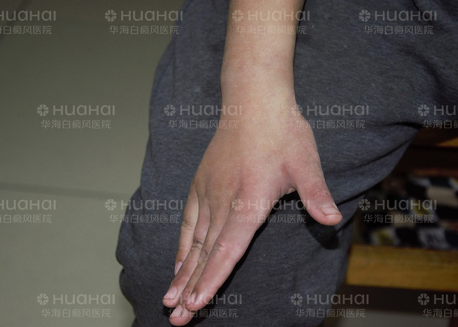 治好手部白癜风重获新生