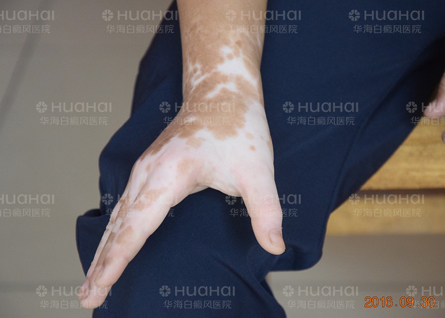 治好手部白癜风重获新生