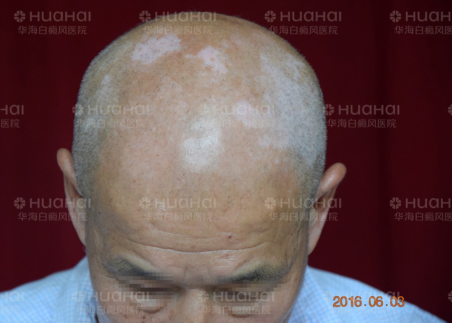 头部白癜风要到白癜风医院正规治疗