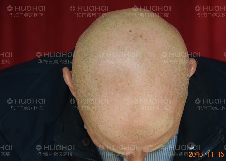 头部白癜风要到白癜风医院正规治疗