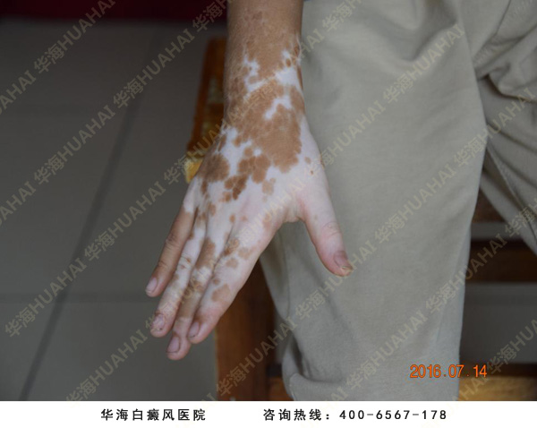 手部白癜风治疗