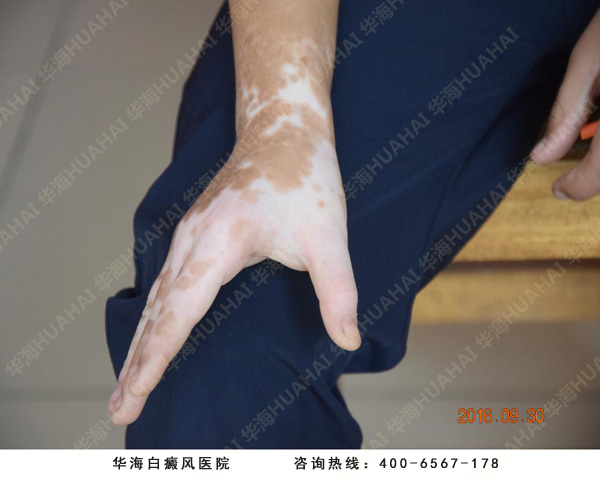白癜风医院治疗手部白斑