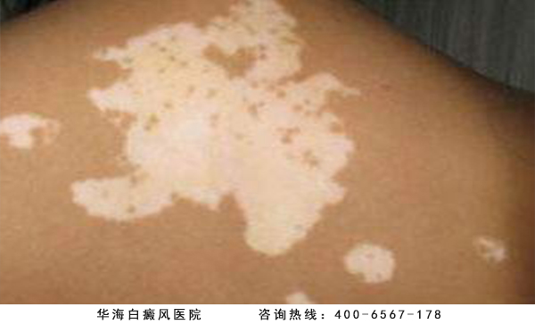 白癜风危害