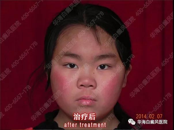 白癜风患者治疗后