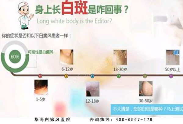 白斑病因
