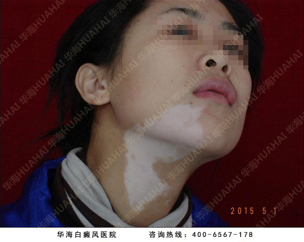 30岁女性白癜风治疗到华海