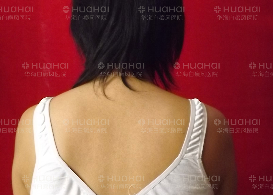 全身长有白癜风别人怕传染