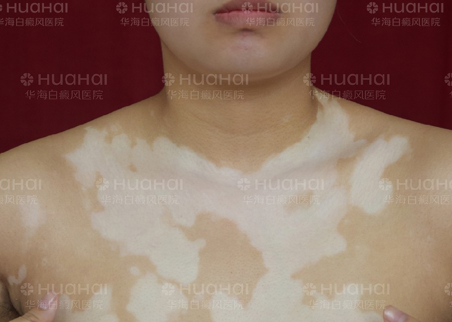 躯干部白癜风患者治疗