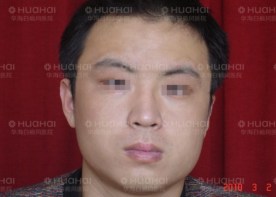 脸部大面积白癜风治疗