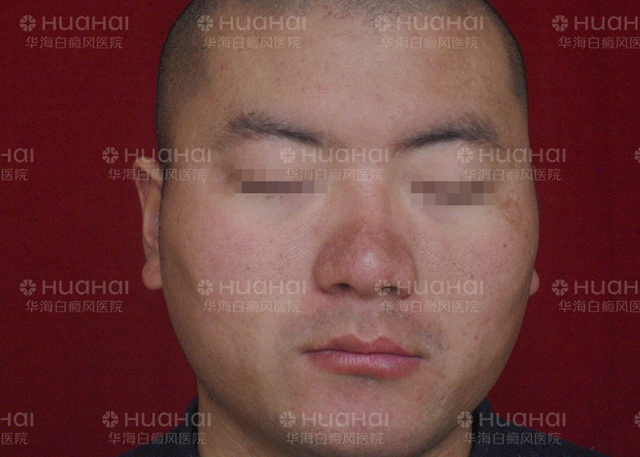 脸上大面积白癜风不能吃什么