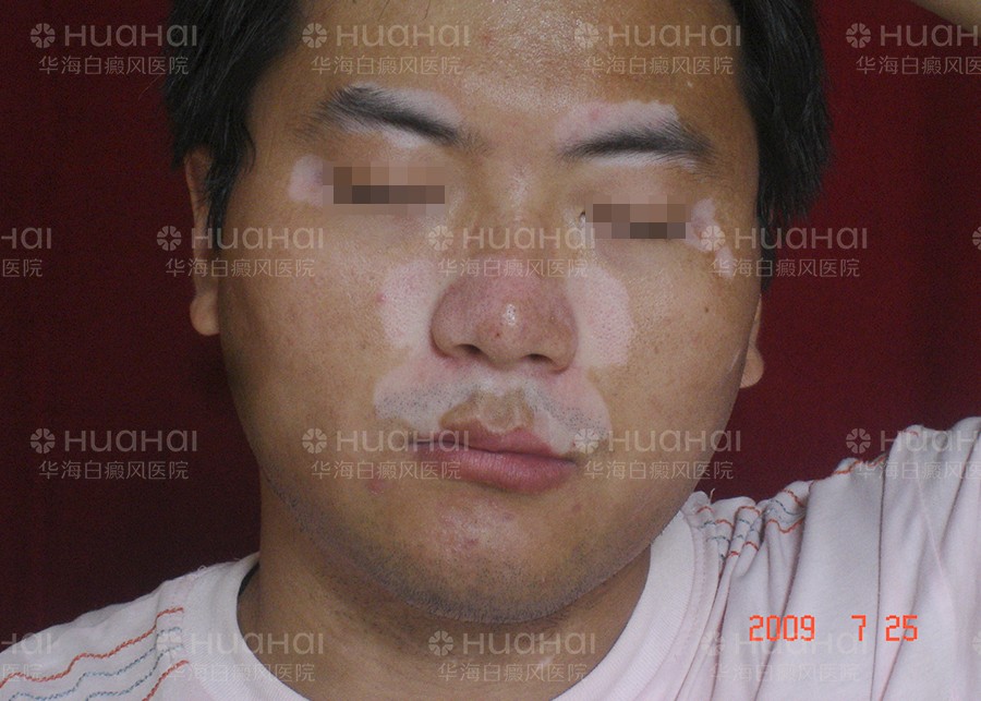 脸上大面积白癜风不能吃什么