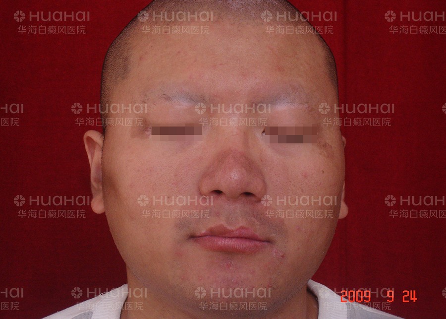 脸上大面积白癜风不能吃什么