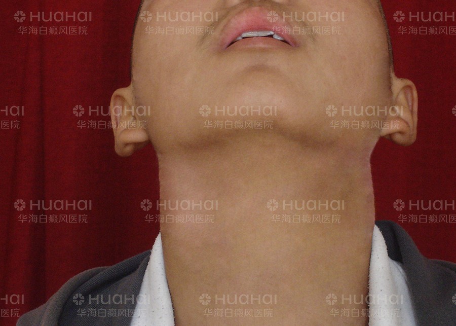 学生白癜风治疗
