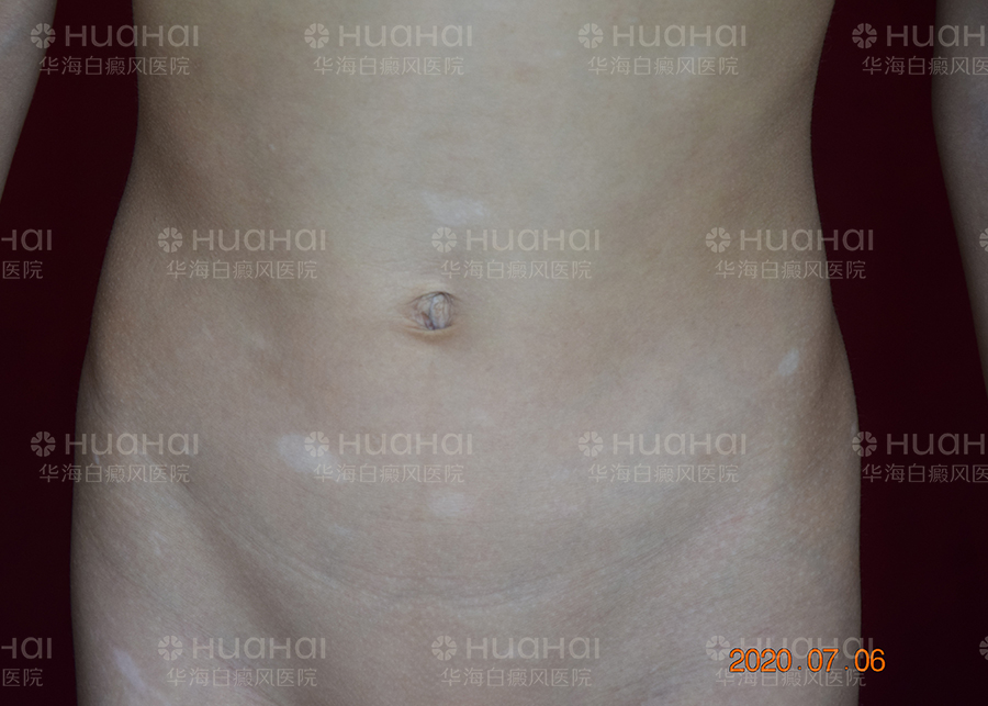 7岁男童腹部患白癜风，4个月康复出院