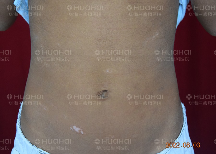 7岁男童腹部患白癜风，4个月康复出院