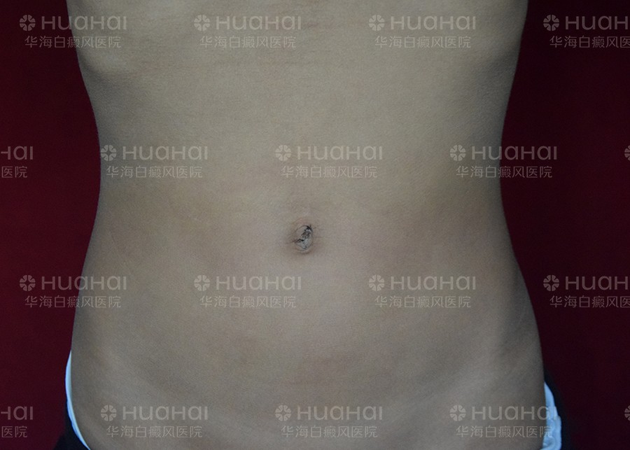 7岁男童腹部患白癜风，4个月康复出院