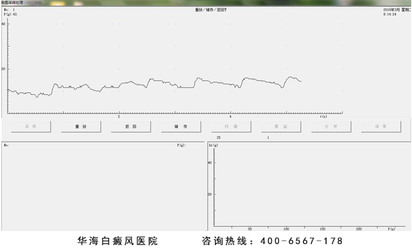 白癜风中医脉象检测