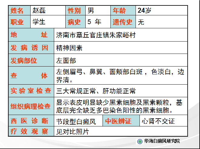 白癜风病因